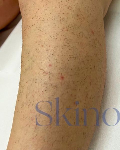 Picior înainte de epilarea laser