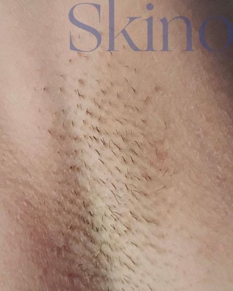 Axilă înainte de epilarea laser
