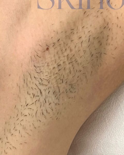 Axilă înainte de epilarea laser